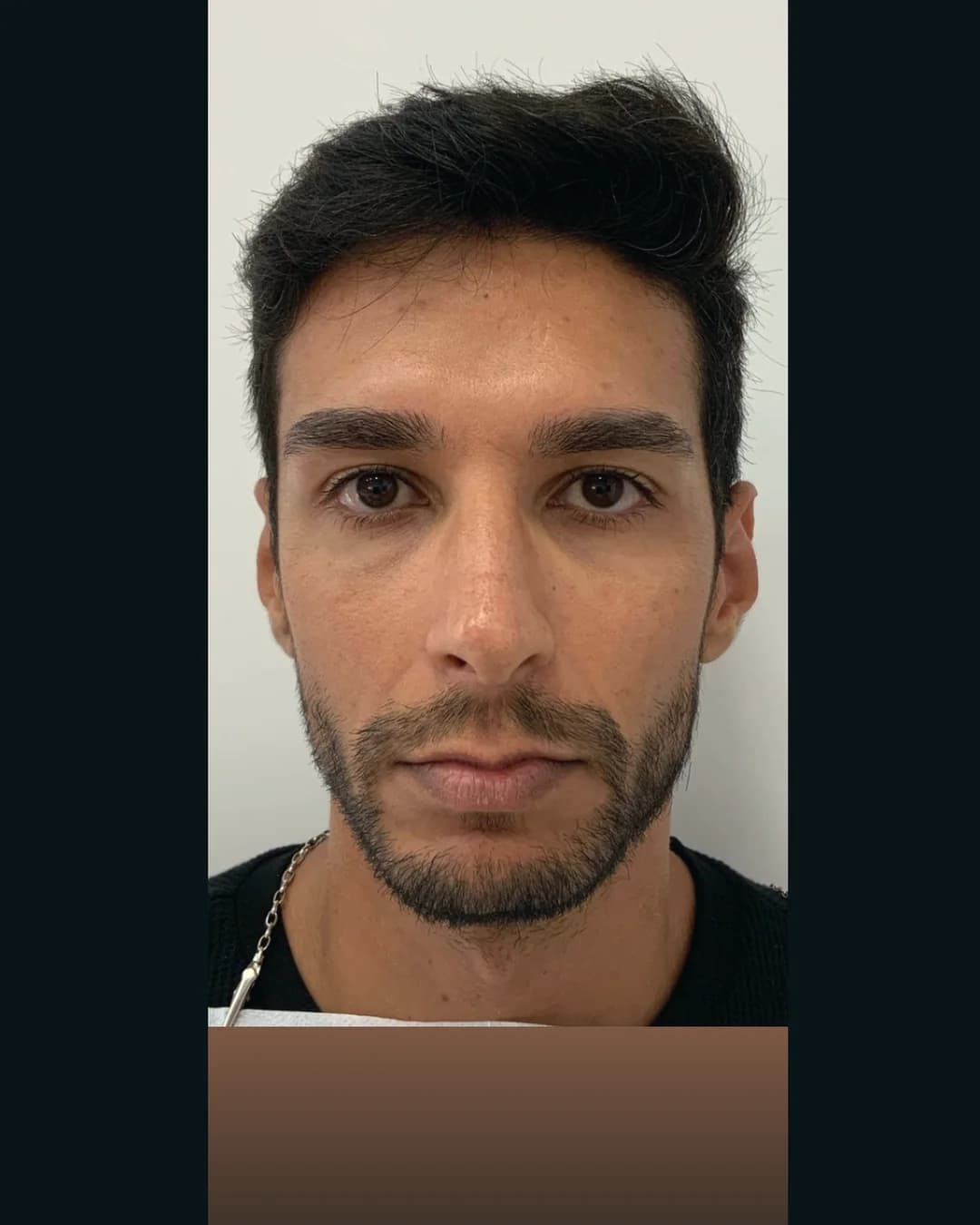 Diagnóstico em vista frontal, paciente M-894